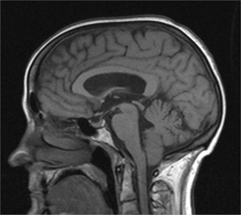 Аномалия Арнольда-Киари фото